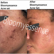 Acne Set