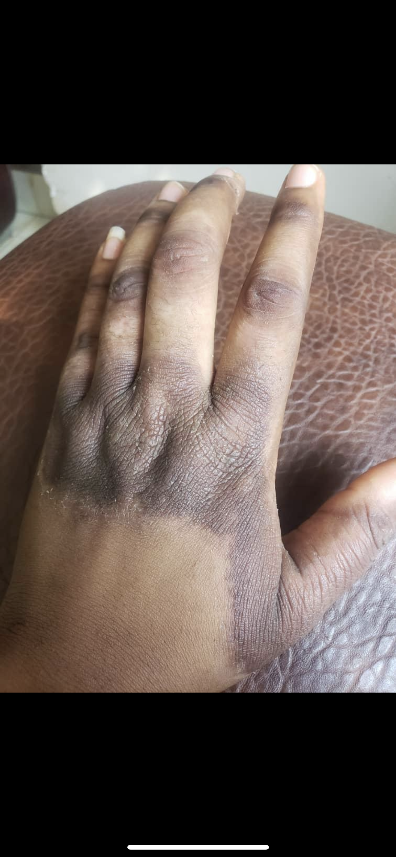 Dark Knuckle Removal Set