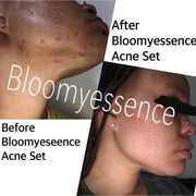Acne Set
